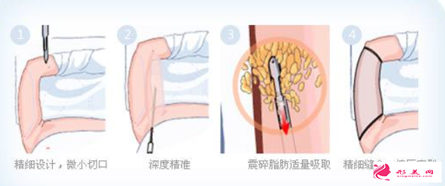 大腿吸脂要注意哪些問題