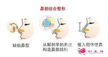 鼻部綜合整形價格多少錢 主要受3點因素影響~