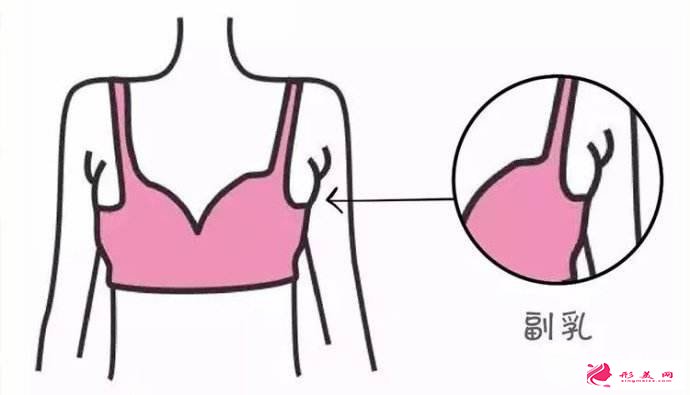 副乳吸脂有風險嗎 輕松趕走“尷尬“贅肉!