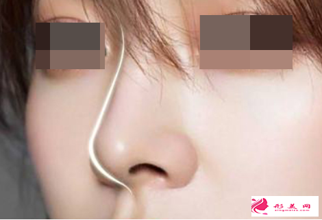 自體軟骨隆鼻后會變形嗎