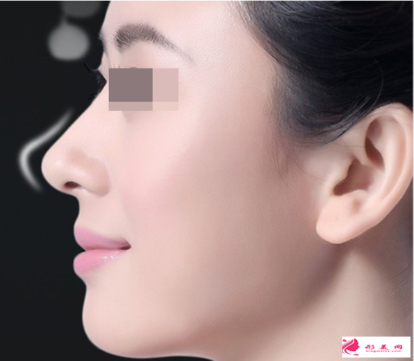 自體軟骨隆鼻后可以抽煙嗎