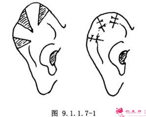 扇風(fēng)耳的治療價(jià)錢需上萬(wàn)元嗎
