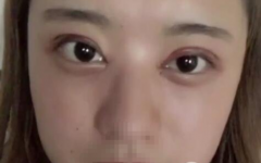 武漢恩吉娜段小兵雙眼皮案例-沙雕小姐姐歡樂美眼日記