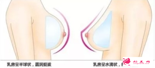 假體隆胸包膜攣縮會(huì)有什么癥狀