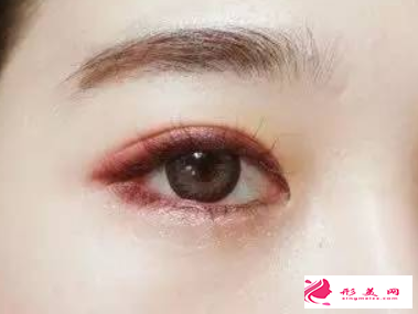 切開雙眼皮多久才能拆線