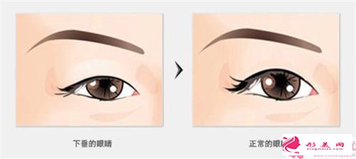 鼻孔矯正手術(shù)前和手術(shù)后需要做的事情
