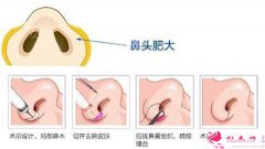 鼻翼縮小手術(shù)流程和疤痕護(hù)理