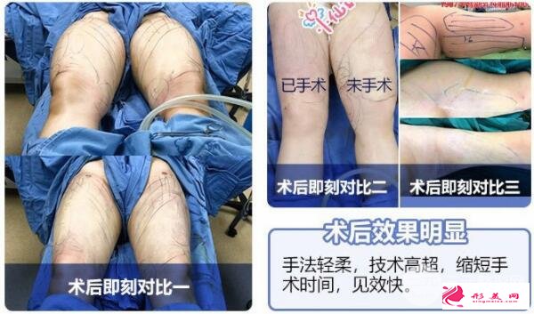 大腿吸脂術(shù)效果圖