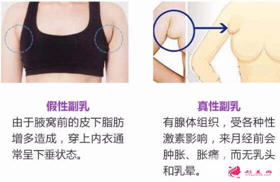 副乳手術(shù)需要多少錢？副乳竟然分“真假”