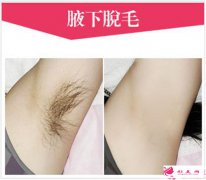 超冰和冰點脫毛的區(qū)別
