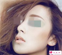 注射式隆鼻一年過(guò)后美容效果如何？