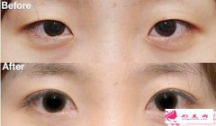 電眼雙眼皮手術(shù)前需要注意什么