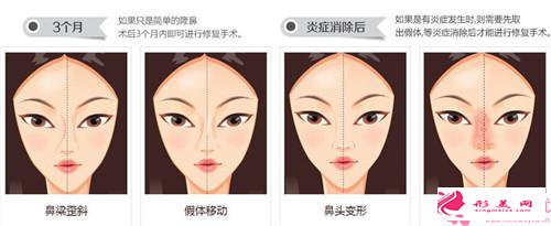 內(nèi)切縮鼻翼后有什么注意事項(xiàng)