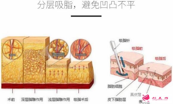 背部吸脂多少錢手術(shù)優(yōu)勢(shì)&效果科普