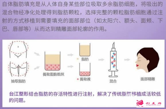 全面部自體脂肪填充效果:美圖放送~
