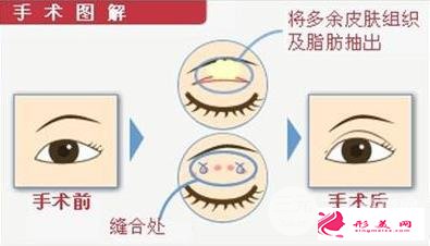 腫眼泡的福星:眼皮抽脂術(shù)效果好不好~