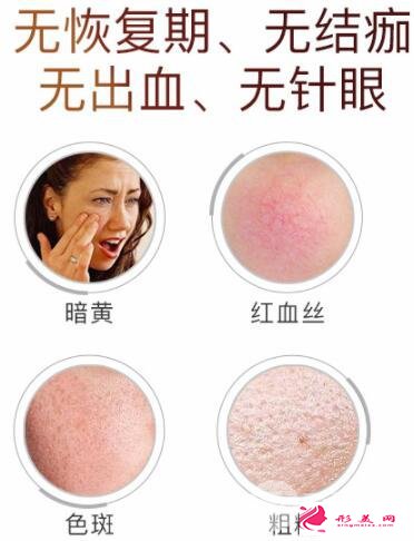 醫(yī)美小課堂:白瓷娃娃激光功效及效果圖