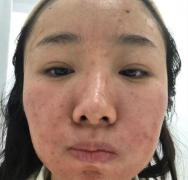 成都華西醫(yī)院激光美容科價格表，附祛斑案例