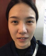 北京八大處李發(fā)成脂肪填充全臉 仙女效果圖曝光！
