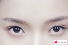 開眼角后出現(xiàn)疤痕增生的情況怎么解決?