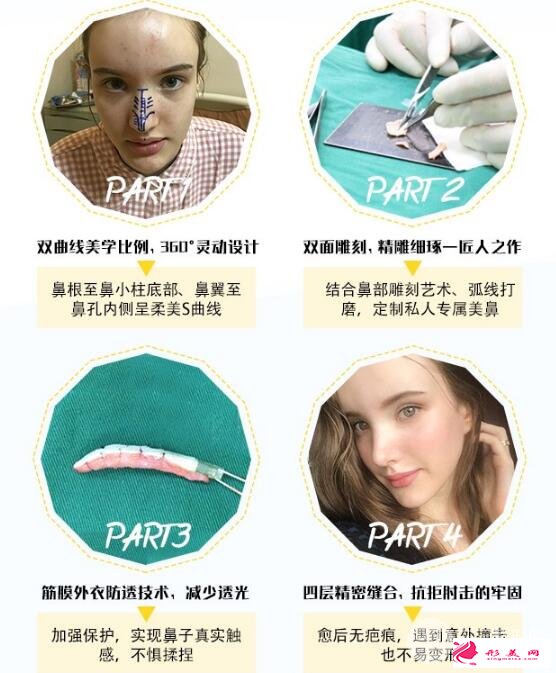 硅膠隆鼻效果好嗎？傳統(tǒng)假體效果也很ok~