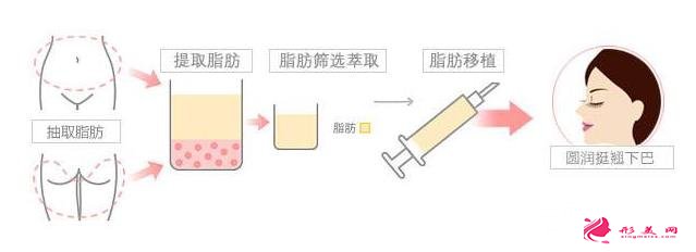 墊下巴多少錢？三種不同墊下巴方式速來Get!