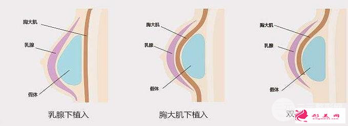 胸部整形手術(shù)多少錢?受三方面因素的影響~