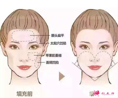 豐面頰手術(shù)詳細(xì)分類，方法竟然有這么多！