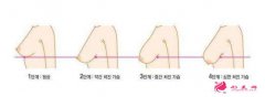 乳房下垂矯正方法有幾種？