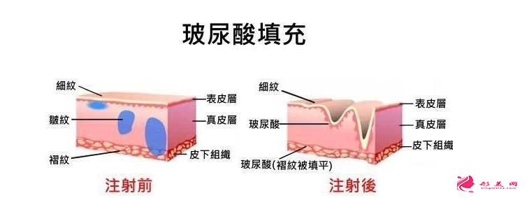 玻尿酸一支多少錢？注射后多久定型？
