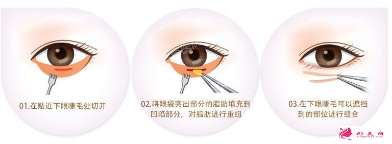 武漢眼袋抽脂一周后能化妝嗎