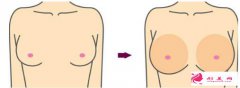 乳房下垂矯正術(shù)的價格是多少？