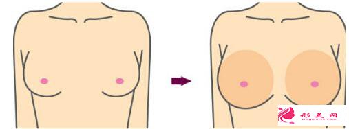 沈陽目前做乳房下垂矯正術(shù)大概需要20000-60000元