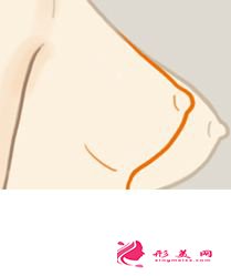巨乳縮小手術(shù)會(huì)不會(huì)反彈回來(lái)呢