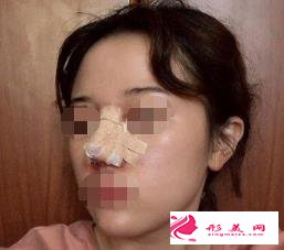 醫(yī)生做的肋軟骨隆鼻效果如何，進(jìn)來瞧瞧吧