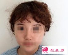 肋軟骨隆鼻效果如何？來看看效果吧