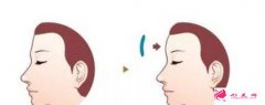 北京額部填充的價(jià)格是多少?