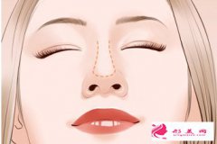 歪鼻矯正手術(shù)讓鼻子更立體