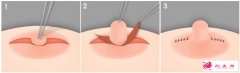 乳頭內(nèi)陷矯正有多少種方法？
