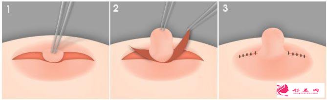 乳頭內(nèi)陷矯正有多少種方法