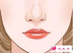 鼻翼縮小效果完全呈現(xiàn)的時間