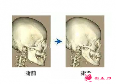 下頜角手術(shù)后會(huì)出現(xiàn)下垂嗎?