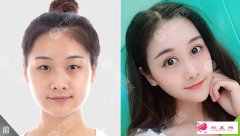  廣州曙光醫(yī)學美容醫(yī)院怎么樣？眼綜合案例分享