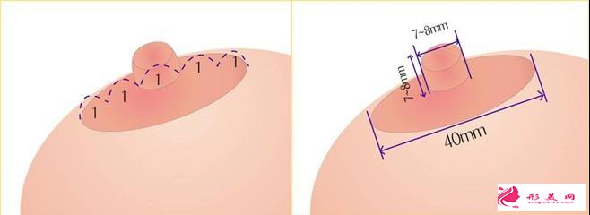哪些女性是需要做乳暈再造手術(shù)的呢