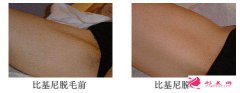 激光比基尼脫毛的效果體現(xiàn)在那？