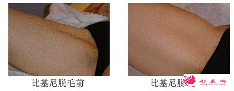 湖南韓美激光比基尼脫毛的效果體現(xiàn)在那
