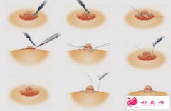 乳暈縮小術(shù)效果明顯嗎？