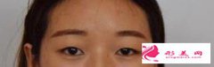 雙眼皮手術(shù)后，展現(xiàn)不一樣的美。