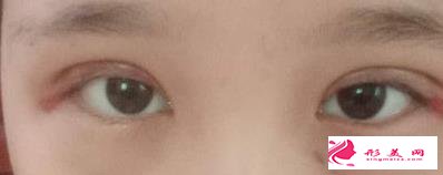 眼綜合拯救了我的正泡眼，選擇醫(yī)生是關(guān)鍵