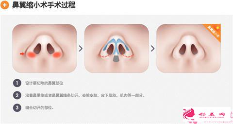 鼻頭縮小的方法有哪些?